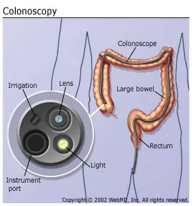 digestive-problems_colonoscopy.jpg